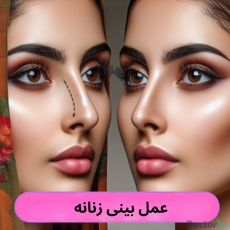 جراحی بینی زنانه