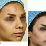 نمونه جراحی بینی دکتر بخشایی کیا (1)