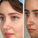 نمونه جراحی بینی دکتر بخشایی کیا (2)