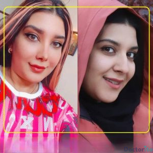 نمونه عمل بینی دکتر اکبر اعتمادی 5