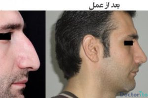 نمونه عمل بینی دکتر عباس نوروزی (2)