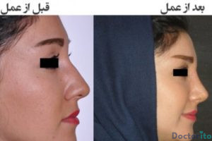 نمونه عمل بینی دکتر عباس نوروزی (3)