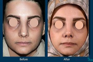 نمونه عمل بینی دکتر علیرضا بابایی (2)
