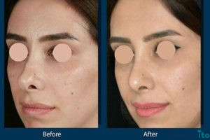 نمونه عمل بینی دکتر علیرضا بابایی (3)