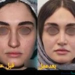 نمونه عمل بینی دکتر فرشته عبدالمطلبی (1)