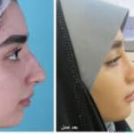 نمونه عمل بینی دکتر فرشته عبدالمطلبی (2)