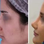 نمونه عمل بینی دکتر فرشته عبدالمطلبی (3)