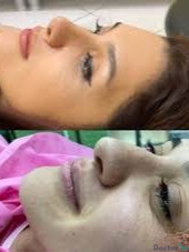 نمونه عمل بینی دکتر پریسا مقدم (1)