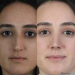 نمونه عمل بینی دکتر شاهین کریمیان