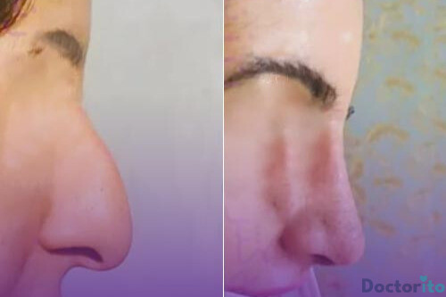 نمونه عمل بینی دکتر سلیمان زندی2