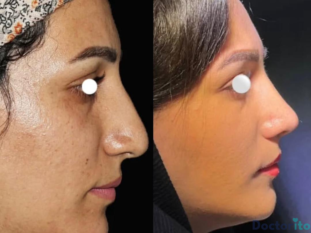 عمل بینی طبیعی زنانه 2