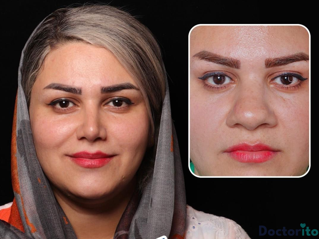 عمل بینی طبیعی زنانه 3