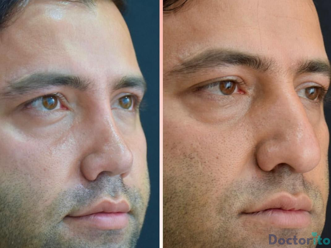 عمل بینی طبیعی مردانه 2