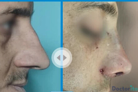 نمونه عمل بینی دکتر سلیمان زندی5