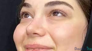 نمونه عمل بینی دکتر علی حسینی واجاری3