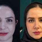 عکس عمل بینی گوشتی2