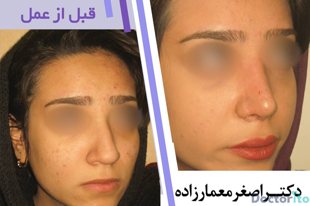 نمونه عمل بینی دکتر اصغر معمارزاده (5)