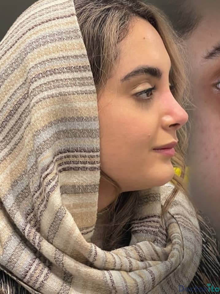 نمونه عمل بینی دکتر سید محمد طالب زاده (7)