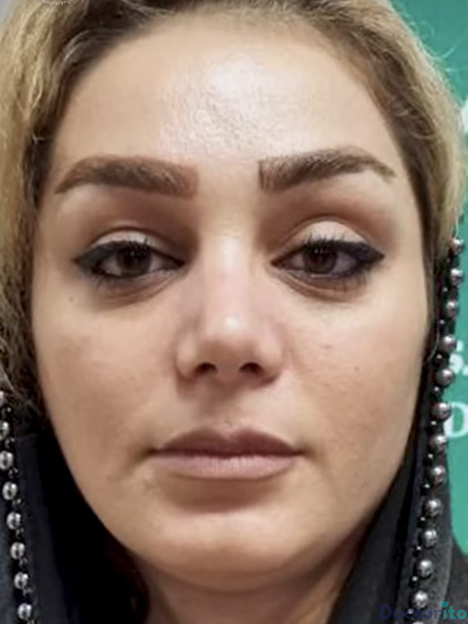 نمونه عمل بینی دکتر علی حسین واجاری (4)