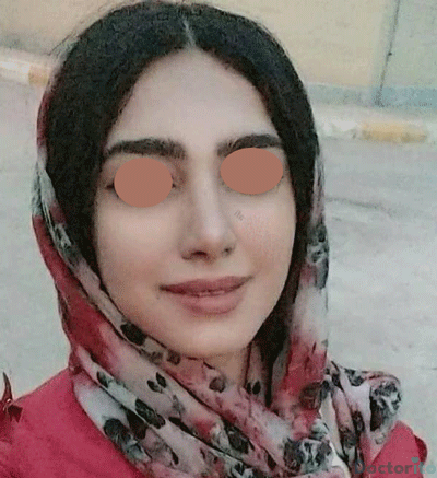 نمونه عمل بینی دکتر علیرضا پورصیرفی (5)