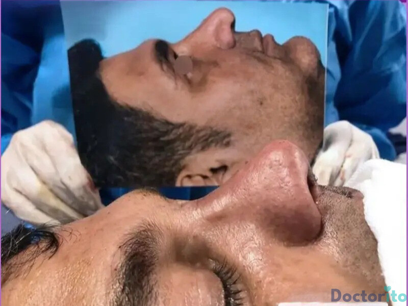 نمونه عمل بینی دکتر مهدی قدیری (2)