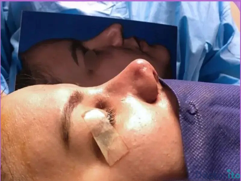 نمونه عمل بینی دکتر مهدی قدیری (5)