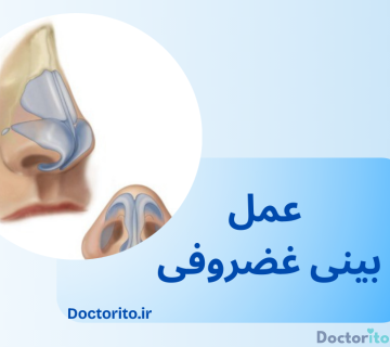 عمل بینی غضروفی