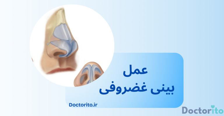عمل بینی غضروفی